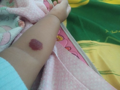 Hemangioma