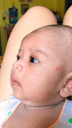 ผดผื่น แก้ด้วยวิธีไหน