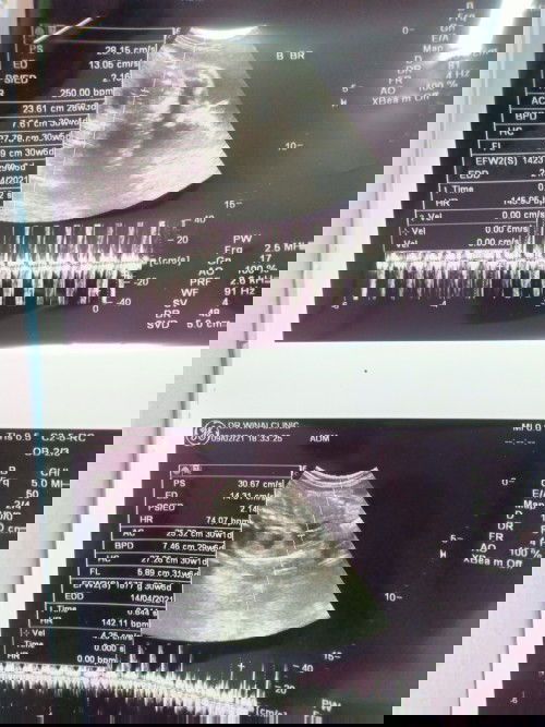 นน.พี่1577น้อง1423 อายุครรภ์29วีค น้อยมั้ยคะสำหรับเด็กแฝด