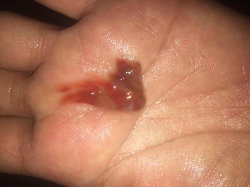 38+5 วีกคะ วันนี้มีมูกเชือดออกแล้วกะหน่วงๆ