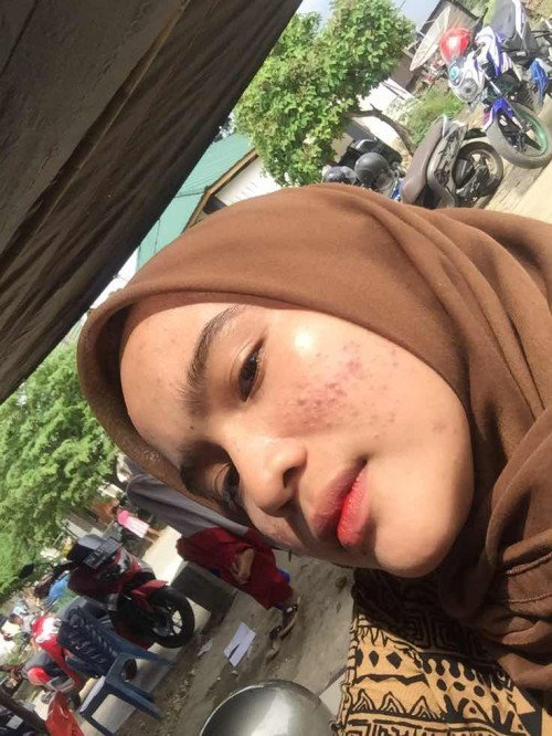 Kulit wajah saat hamil