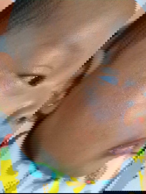 Bintik merah di wajah