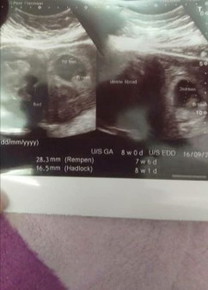 Hye nk tya sblm ni bln 11 check upt -ve..scan nmpk fibroid je...tp sbb OP ditangguh sbb pkp..scan2