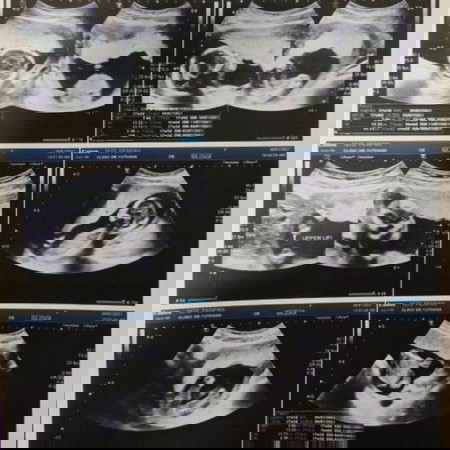 ดาวซินโดรมค่ะ