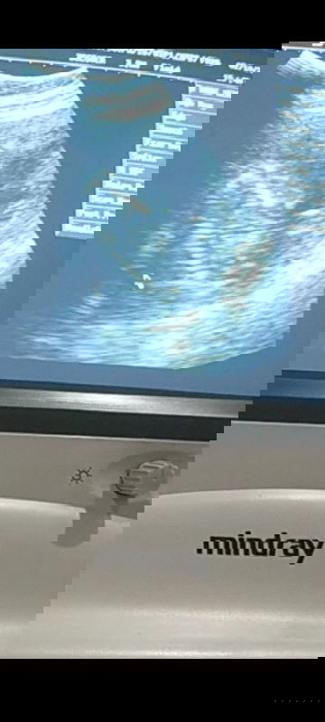 Nakaupo si baby sa loob ng tiyan. Is this normal? may way ba para humiga sya ulit?