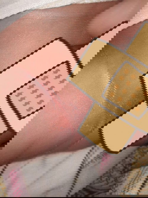 Lecet atau ganti kulit..