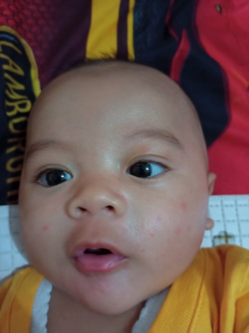 Ruam di pipi