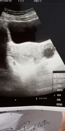 Hamil 4 minggu kista 2cm