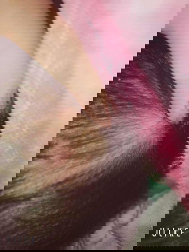 mụn mủ trên đầu