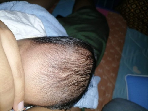 ลูกหัวปูดเเม่ท่านไหนมีประสบการณ์เเบบนี้บ้าง