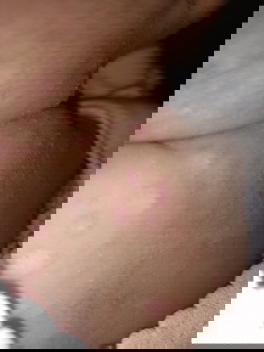 Ruam/ Biang Keringat Baby New born