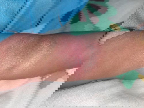 About rashes ni baby