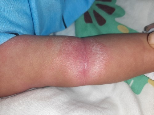 About rashes ni baby