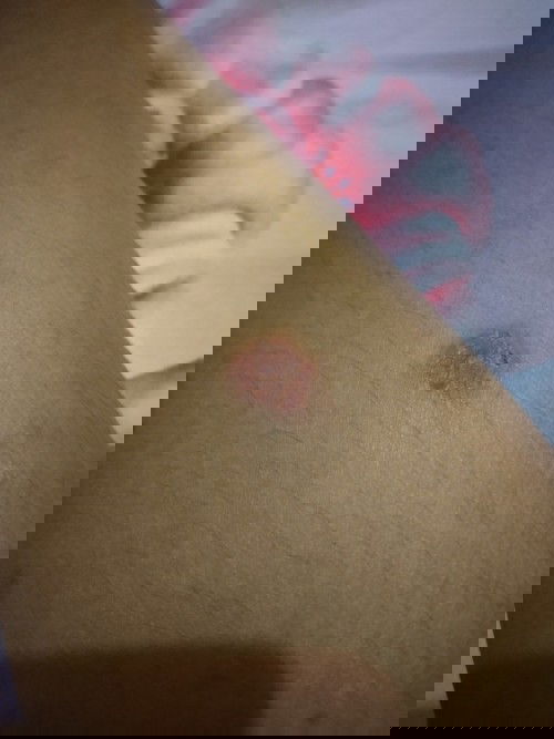 Gatal gatal pada kulit tangan dan kaki