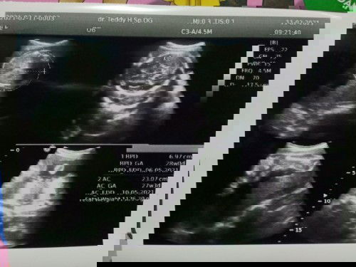 BBJ normal apa tidak??