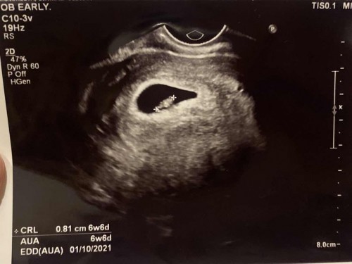 ตั้งครรภ์ 7 week