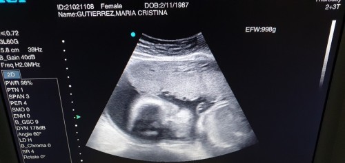 Breech Baby