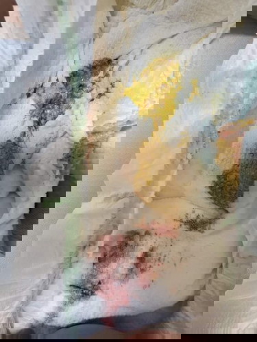 Blood in baby’s poop