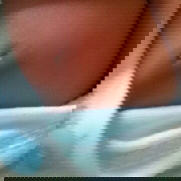 payudara bayi bengkak