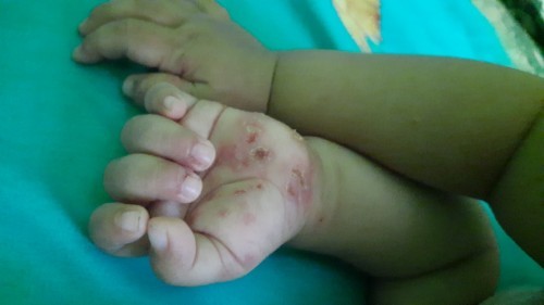 Ada yg pernah ngalamin gini gk bun anak nya...kira2obat atw salep nya aps ya..