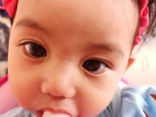 ตุ๋มใต้ตา????