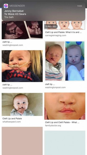 Cleft lip and Cleft palate