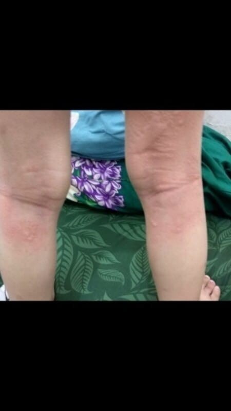 bentol bentol yg tak kunjung sembuh