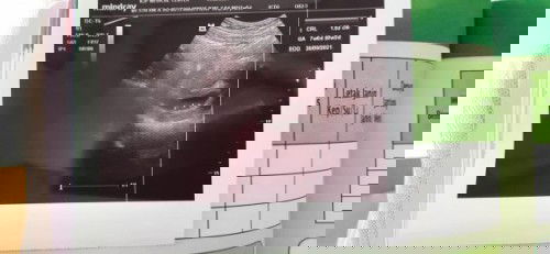 Posisi kantung kehamilan terlalu kebawah