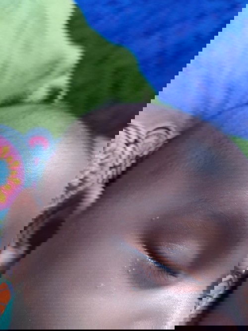 Bintik putih / milia pada bayi