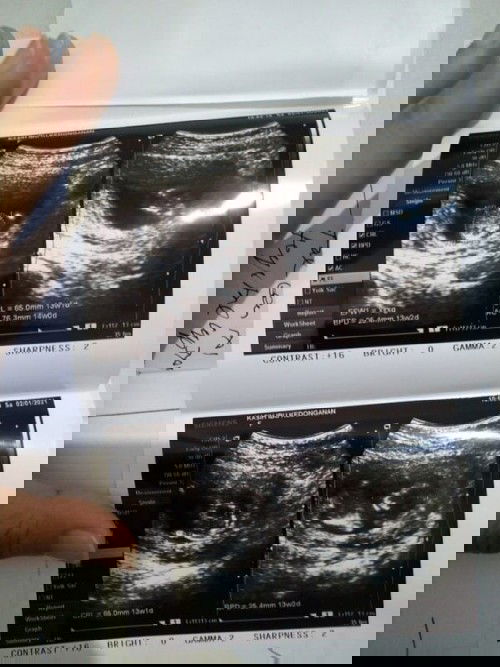 Sharing tentang dokter baik di RS Kasih Ibu (Bali)