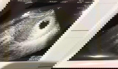 Usg 6w1d sempat dinyatakan BO