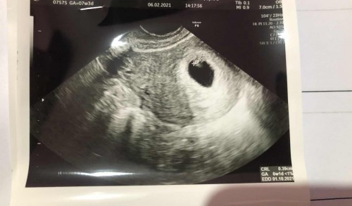 Usg 6w1d sempat dinyatakan BO