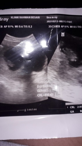 Jantung janin masih samar