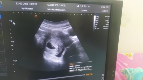 Hasil usg pada kehamilan 7minggu