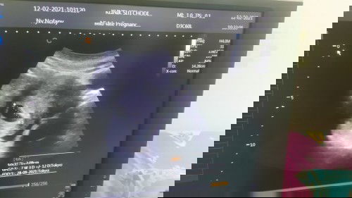 Hasil usg 7minggu tidak terlihat janin