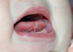 Lidah tongue tie