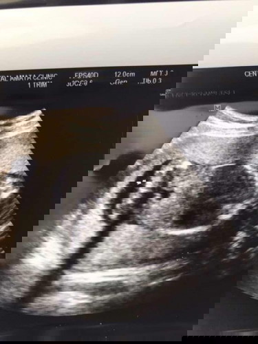 ดูเพศใช่ตรงลูกศรหมอชี้มั้ยค่ะ