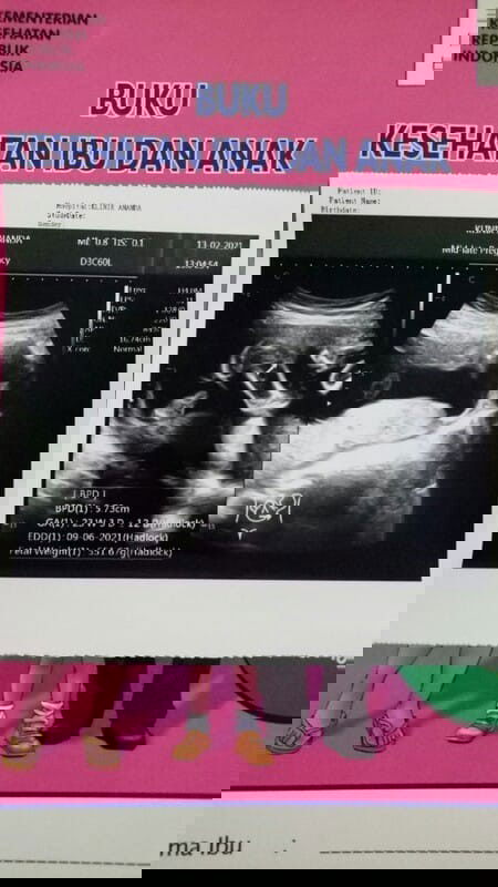 Ari ari dibawah bayi menutupi jalan lahir