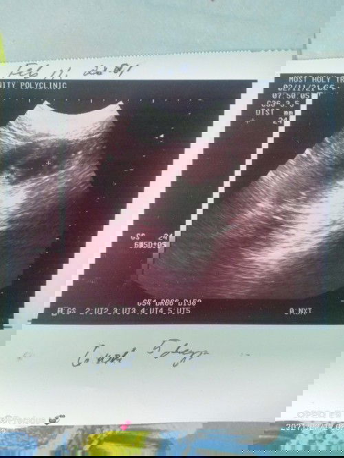 Ultrasound
Sabi PO Ng doctor walang heartbeat