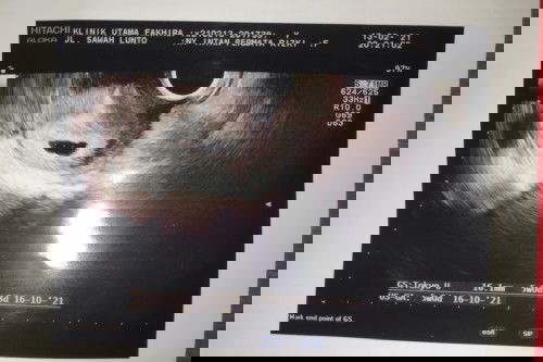 Flek 2 minggu dan pendarahan 2 hari