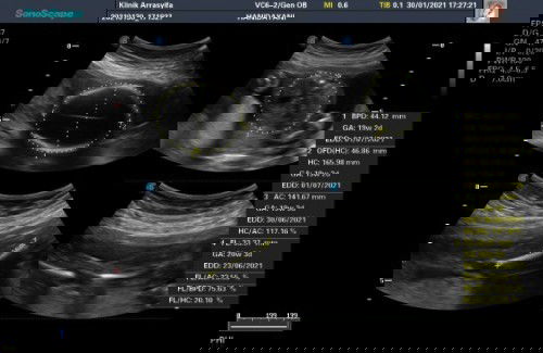 Ini kehamilan ke 6 qu