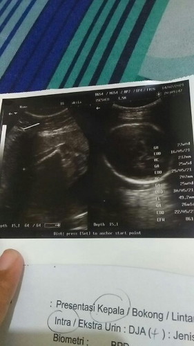 Usg 3D seperti apa?