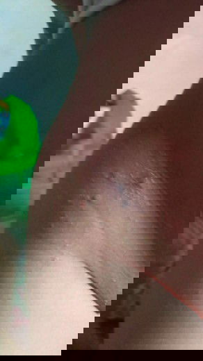 Bundd ada yang tau ga obat untuk gatal pada anak 1tahun 😟😟