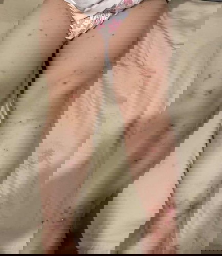 Can any kind souls pls save my kid from severe eczema ??