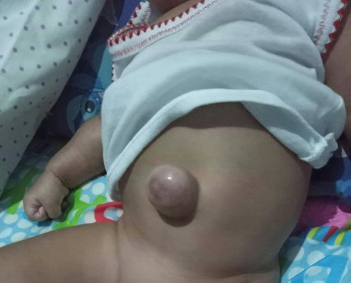 Umbilical hernia