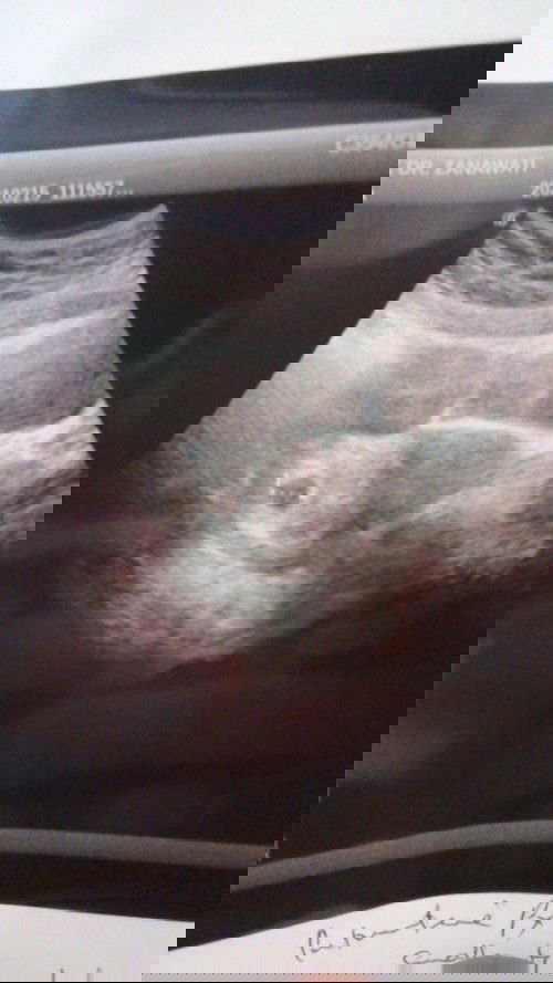 Hai mommies, saya first pregnant dan scan semalam nampak ada 2 cyst yg besar.