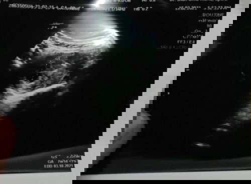 Usia usg dan hpht berbeda