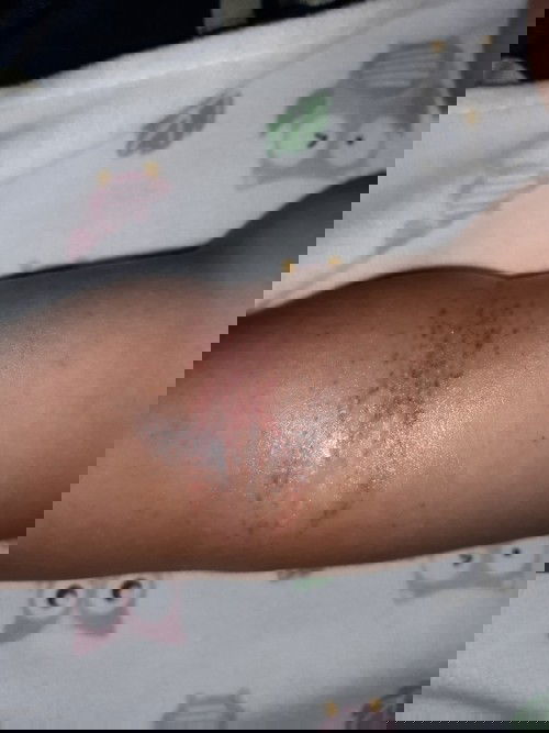 Bintik merah pada lengan