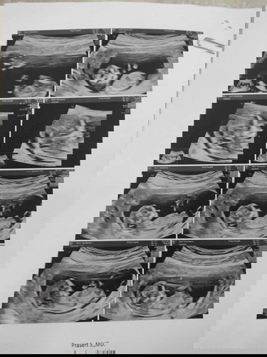 แม่ๆว่าผญ หรือผช.ค่ะส่วนตัวแม่อยากได้ผญ.ค่ะ😁 ขอบคุณนะคะ
#12week
#ทีมเดือนสิงหาคม