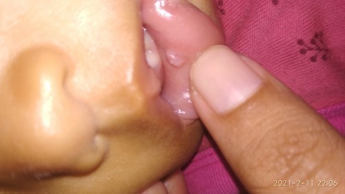 Mucocele